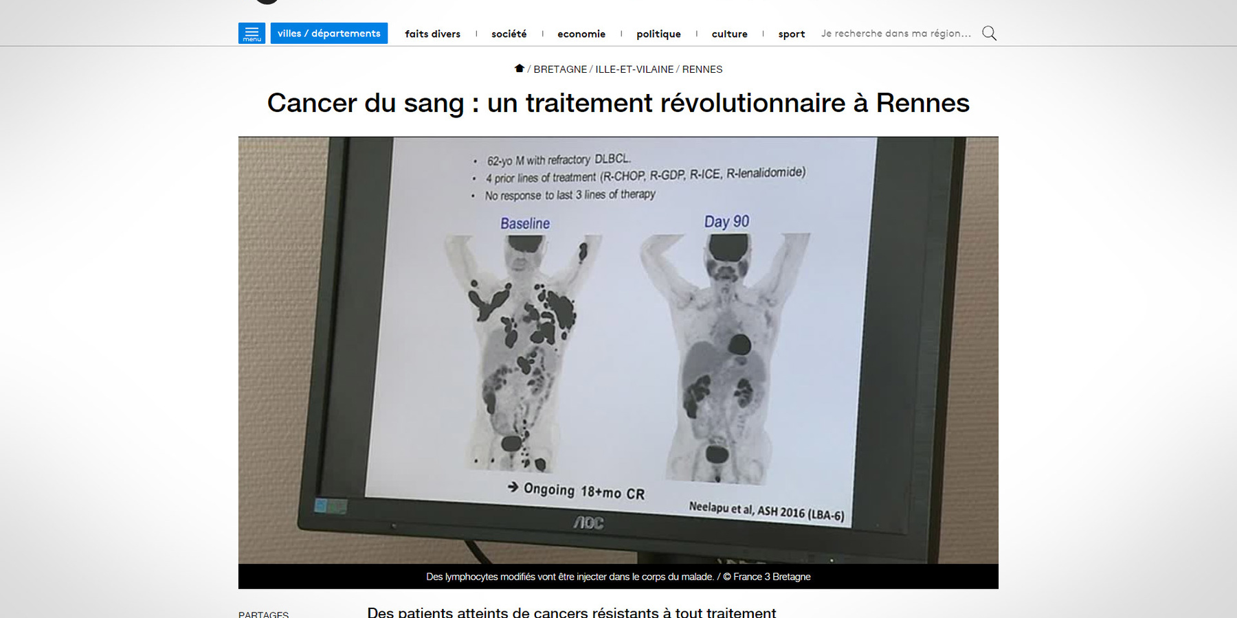 France 3 Bretagne : cancer du sang, un traitement révolutionnaire au CHU de Rennes